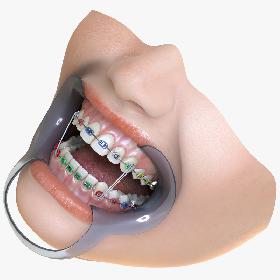Orthodontic Mouth